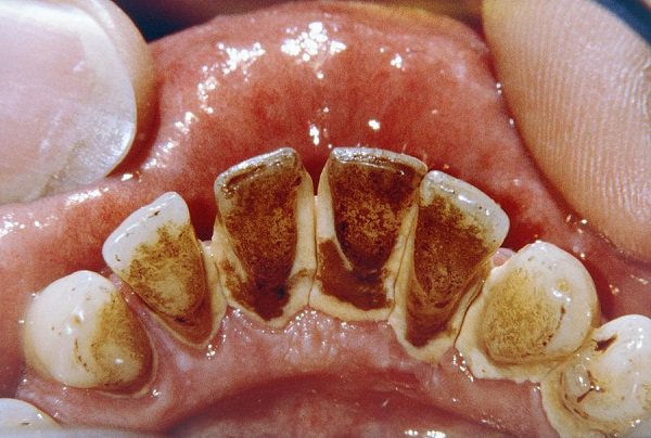 cao răng huyết thanh, cao răng huyết thanh là gì, sự hình thành cao răng, vôi răng huyết thanh, cao răng huyết thanh và cao răng nước bọt
