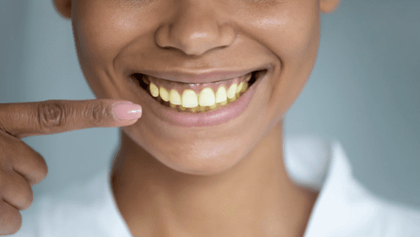 Răng vàng bẩm sinh có tẩy trắng được không? Cách làm trắng răng cho người có răng bị vàng bẩm sinh